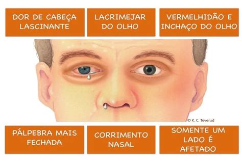 sintomas de cefaleia em salvas-4